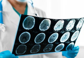 The figures relating to traumatic brain injury (TBI) in New Jersey and the nation are alarming.